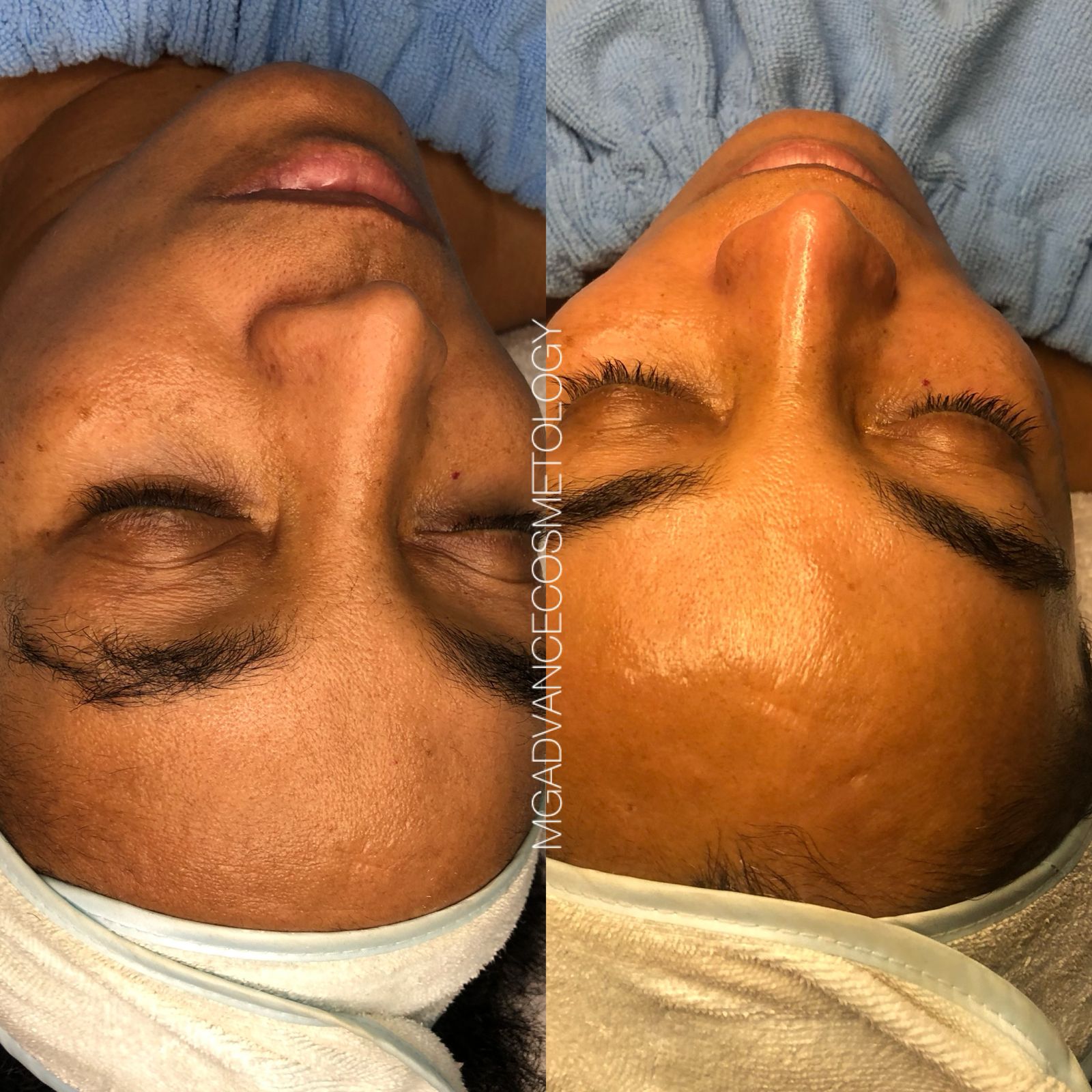 Plasma Rico en Plaquetas