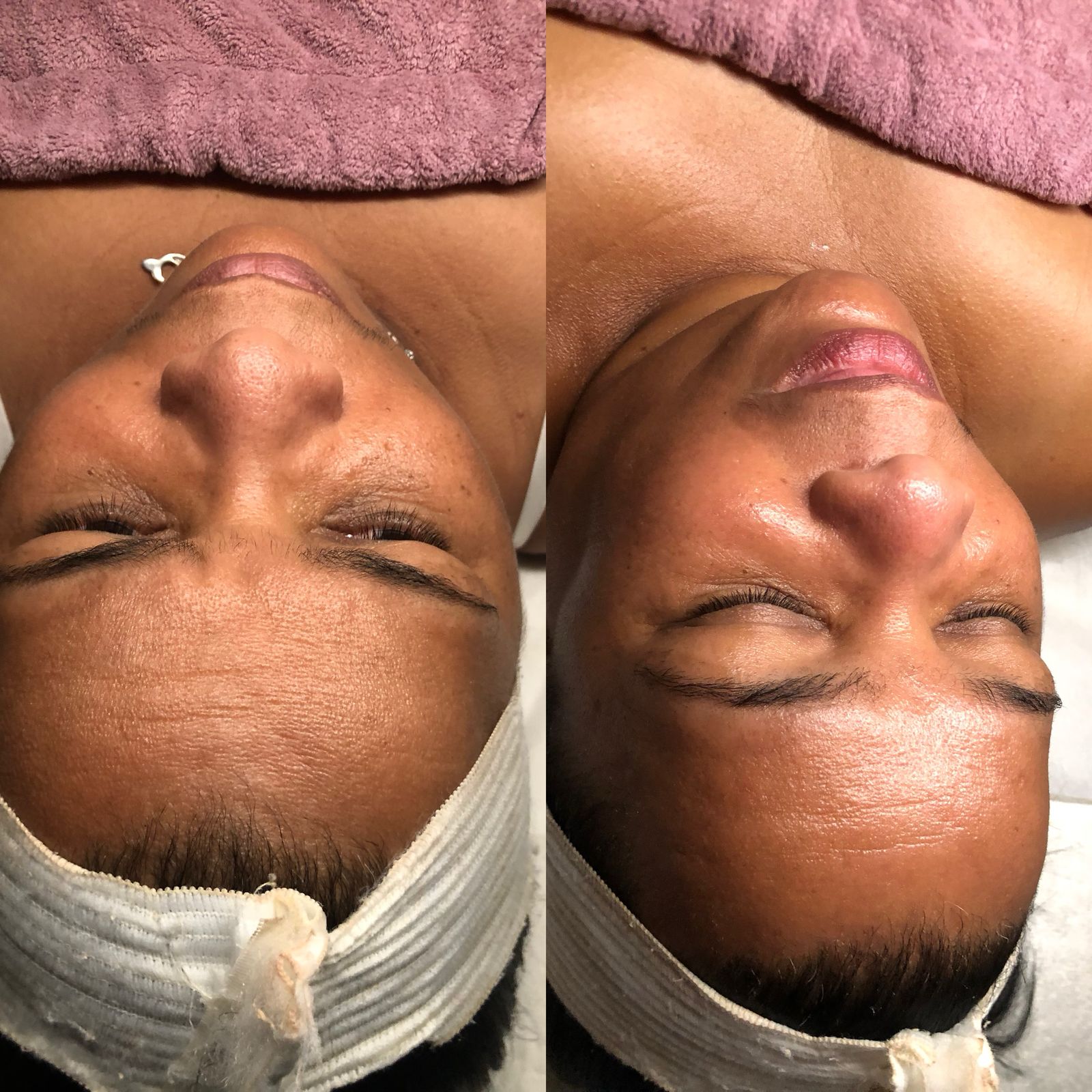 Limpieza Facial