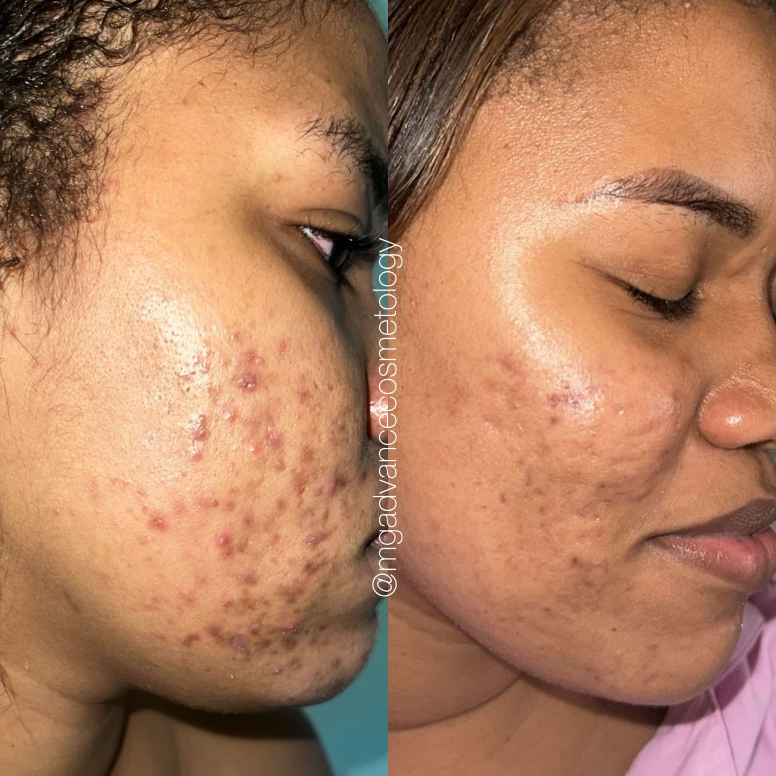 Tratamiento de Acné