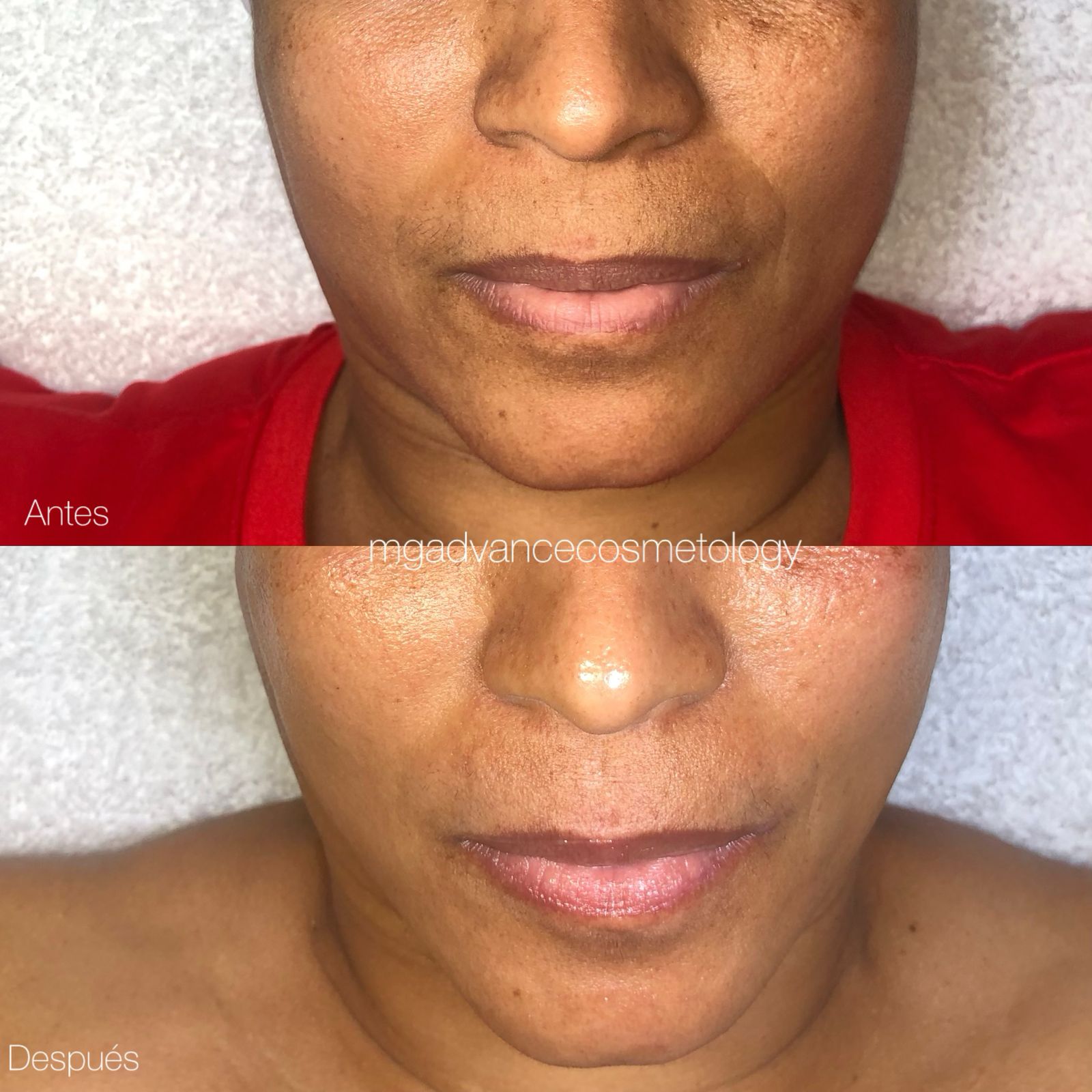 Tratamiento de Ojeras