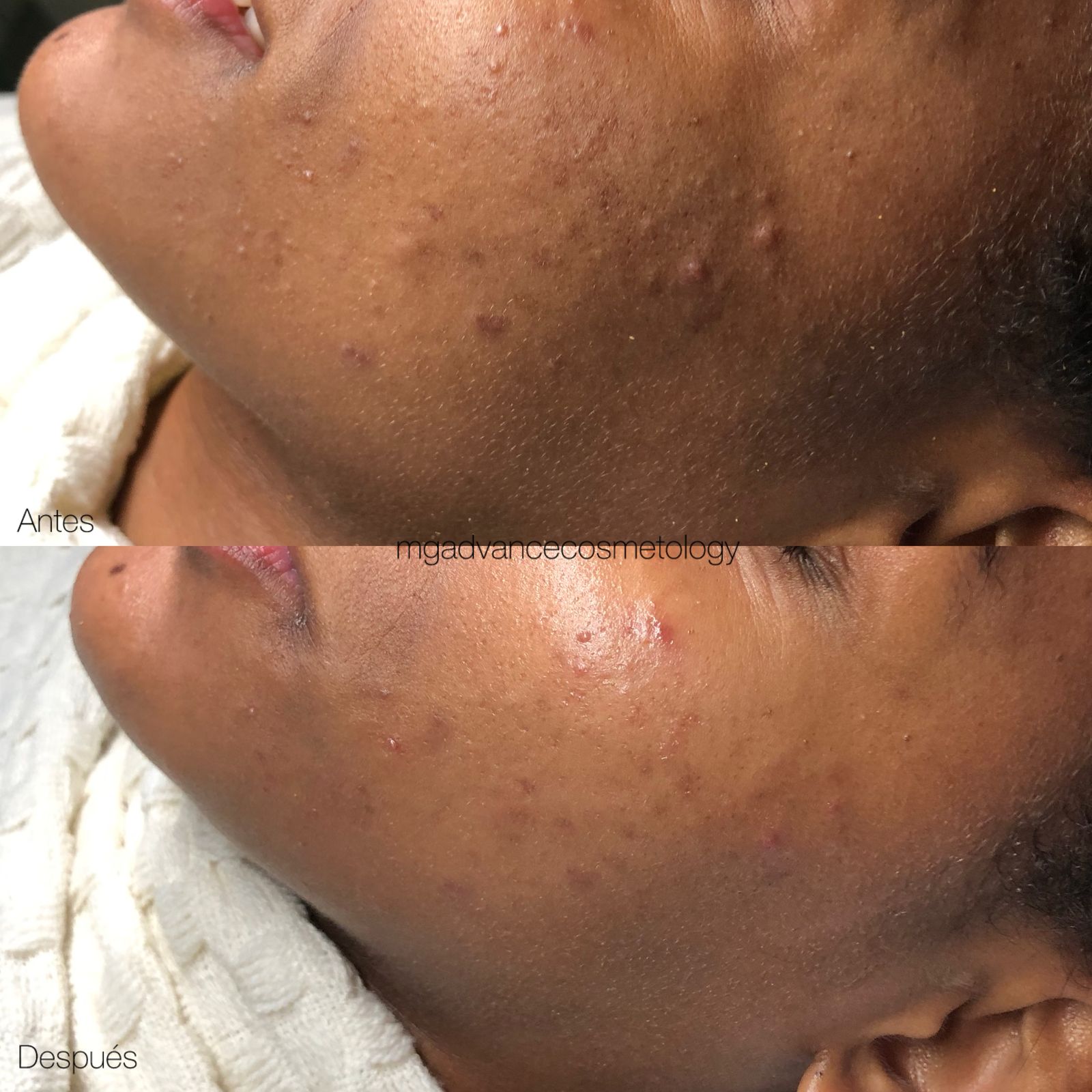 Tratamiento Personalizado